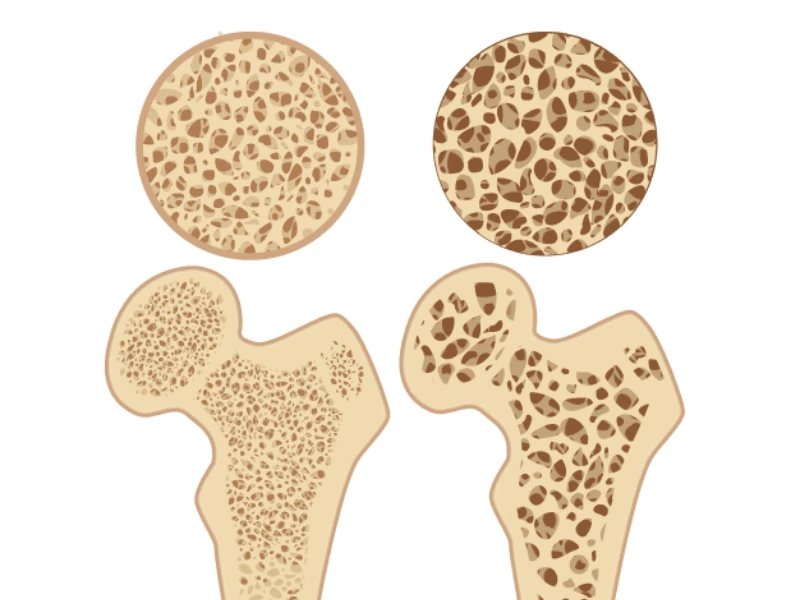 پوکی استخوان
