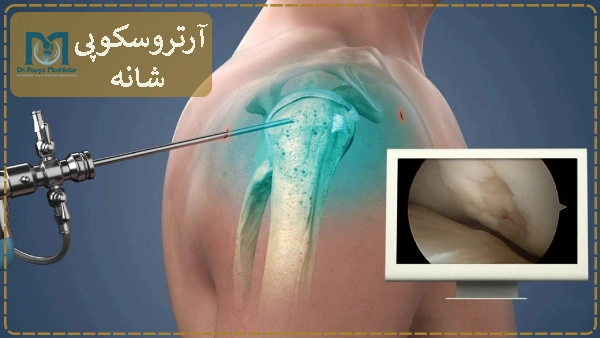 آرتروسکوپی شانه چیست؟