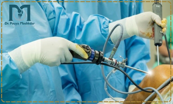 آرتروسکوپی شانه