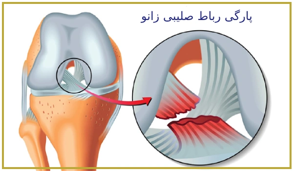 پارگی رباط صلیبی 