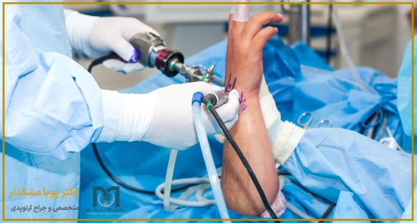 عمل جراحی آرتروسکوپی مچ دست