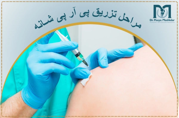 مراحل تزریق پی آر پی شانه