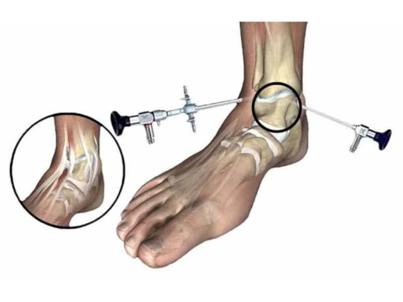 مزایای عمل آرتروسکوپی مچ پا در درمان آسیب‌ها