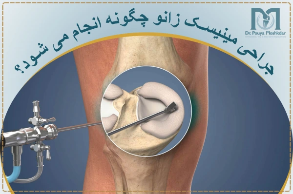 جراحی مینیسک زانو چگونه انجام می شود؟