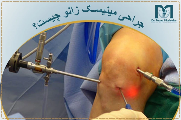 جراحی منیسک زانو چیست؟