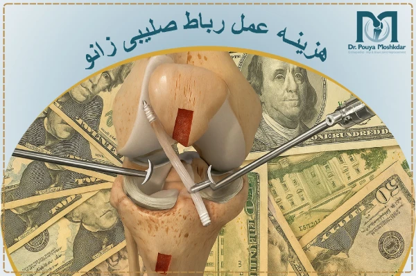 هزینه عمل رباط صلیبی زانو