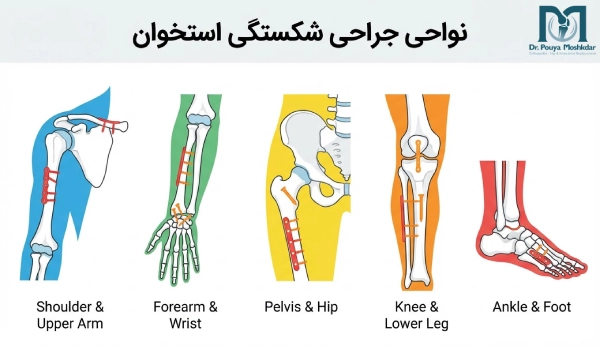 نواحی انجام جراحی شکستگی استخوان