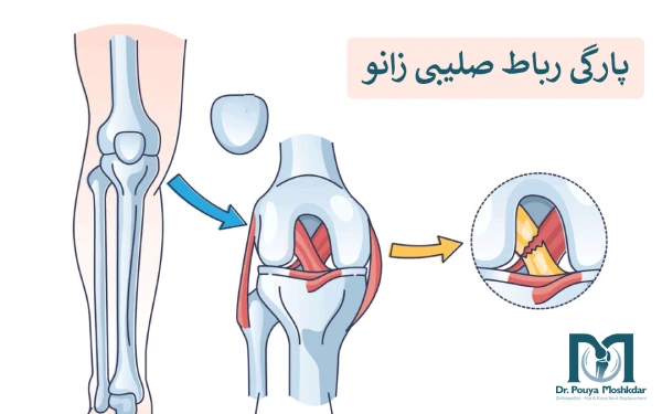 پارگی رباط صلیبی زانو