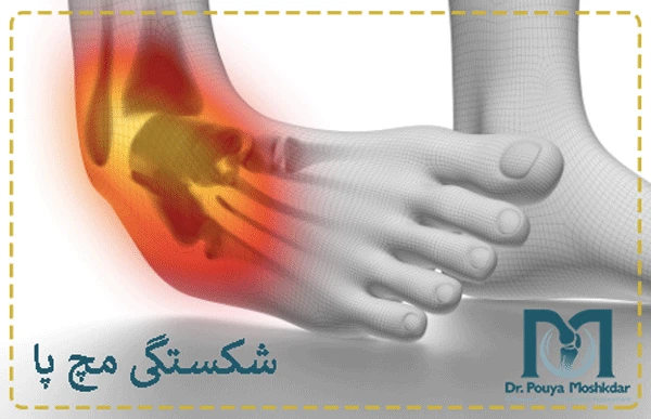 شکستگی مچ پا