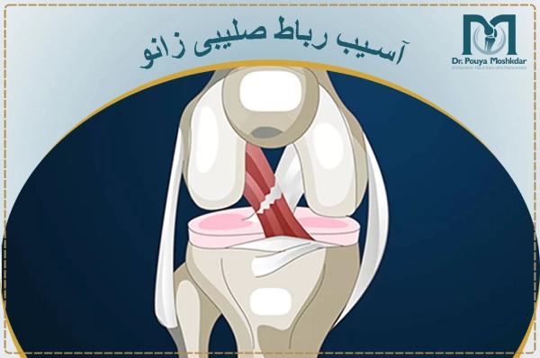 اسیب رباط صلیبی زانو