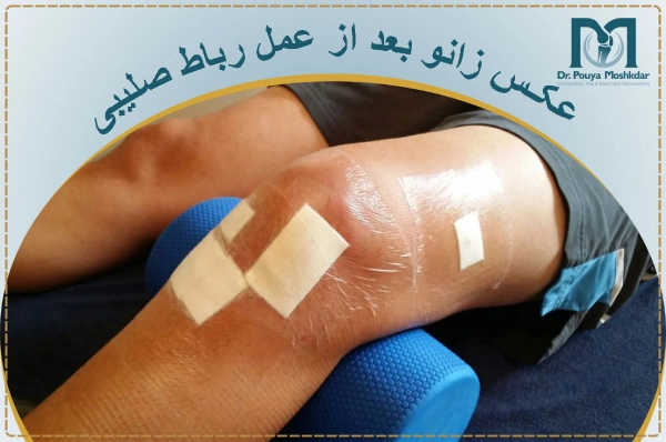 عکس زانو بعد از عمل رباط صلیبی زانو عکس زانو بعد از عمل رباط صلیبی زانو
