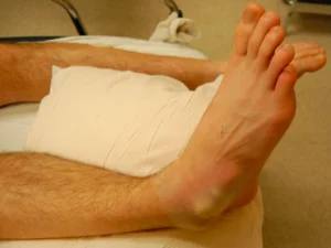 دررفتگی مچ پا