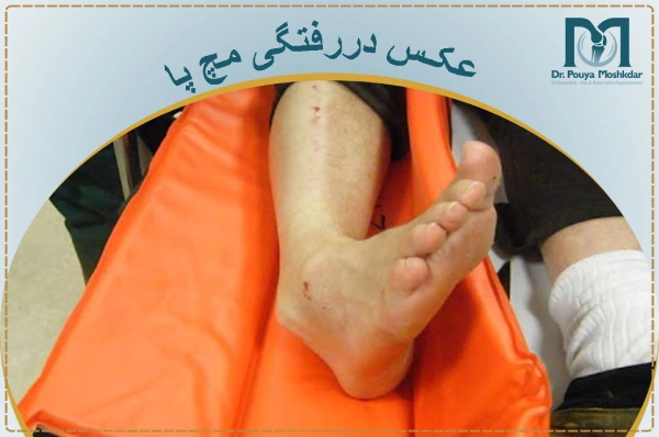عکس دررفتگی مچ پا