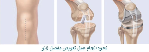 عمل تعویض مفصل زانو