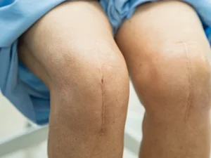 مراحل عمل تعویض مفصل زانو