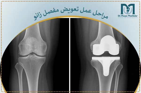 مراحل تعویض مفصل زانو