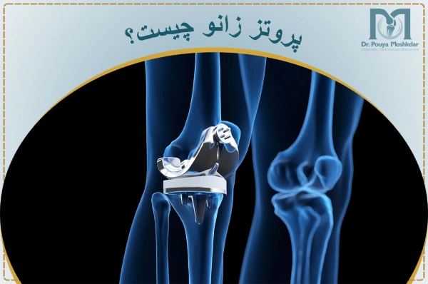 پروتز زانو چیست؟