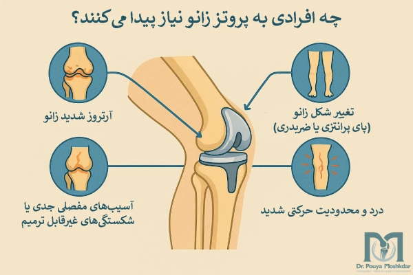 چه افرادی به پروتز زانو نیاز پیدا میکنند؟