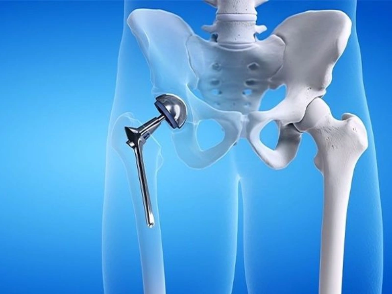هزینه عمل تعویض مفصل لگن