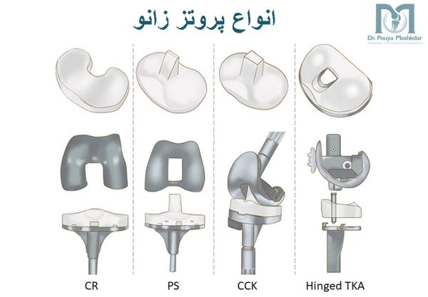 انواع پروتز زانو