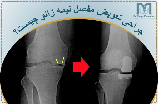 جراحی تعویض مفصل نیمه زانو